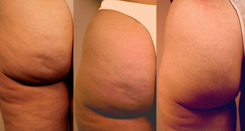 celulitis-nunca-mas.jpg