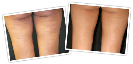 No mas celulitis